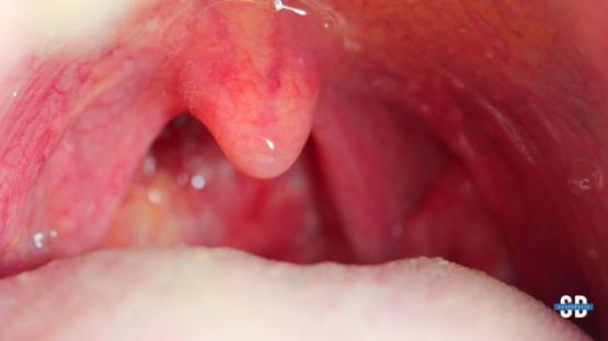 Strep Throat