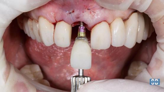 How long does a single tooth implant last?