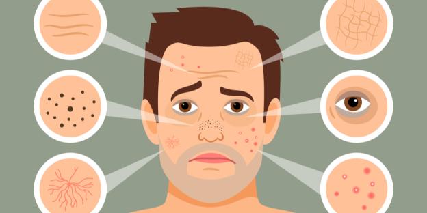 Adult Acne in Men: Causes, Treatments, and Prevention Strategies